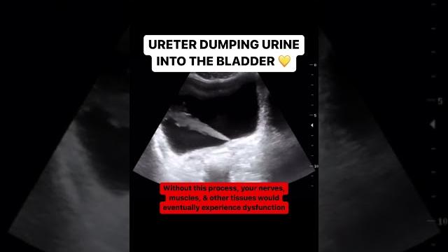 Ureter jetting urine into the bladder Ureter jetting urine into the bladder