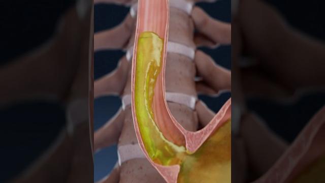 Acid reflux, gerd, and heartburn explained in 3d Acid reflux, gerd, and heartburn explained in 3d