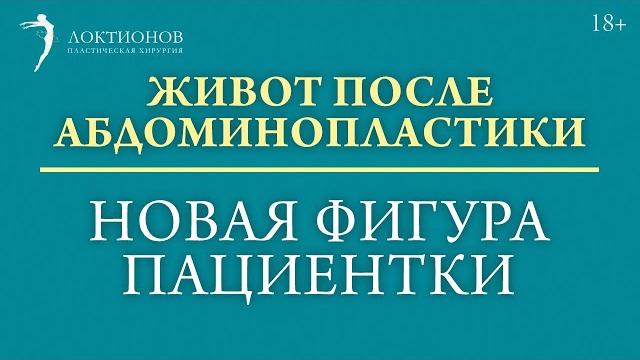 Убрали лишнюю кожу на животе. часть 2 #shorts Убрали лишнюю кожу на животе. часть 2 #shorts