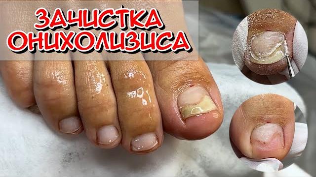 Cleaning up onycholysis / the nail has moved away from the bed / there is emptiness under the nail Cleaning up onycholysis / the nail has moved away from the bed / there is emptiness under the nail