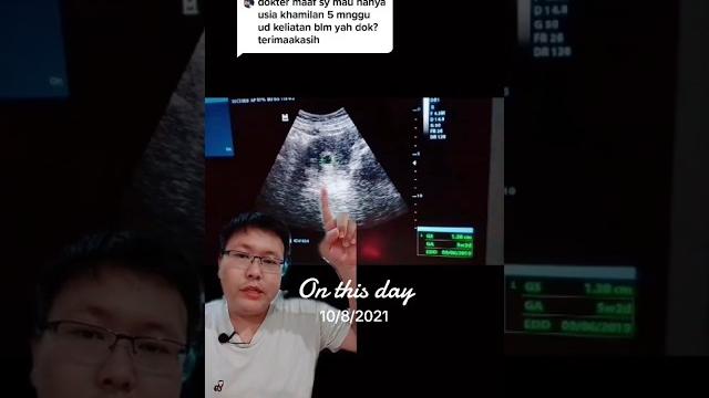 Hamil 5 minggu di usg seperti apa? Hamil 5 minggu di usg seperti apa?