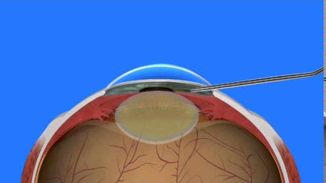 Cataract surgery Cataract surgery