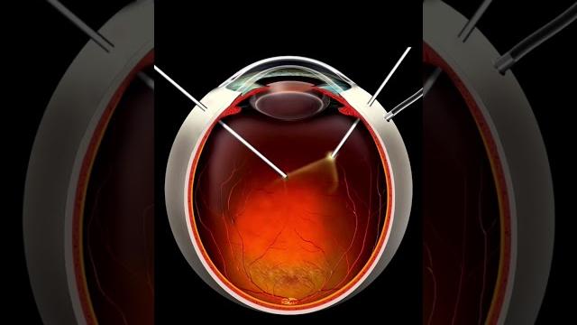 How is vitrectomy done? vitrectomy can change your life if you have diabetic retinopathy How is vitrectomy done? vitrectomy can change your life if you have diabetic retinopathy