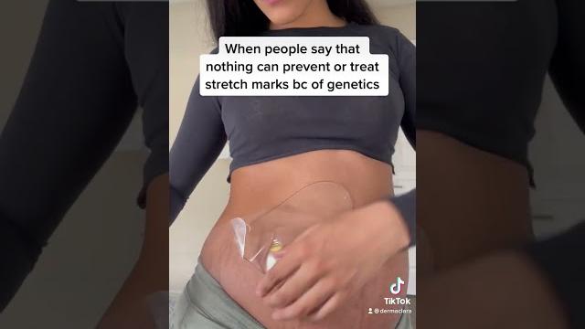 Clinically proven stretch mark treatment ️ Clinically proven stretch mark treatment ️