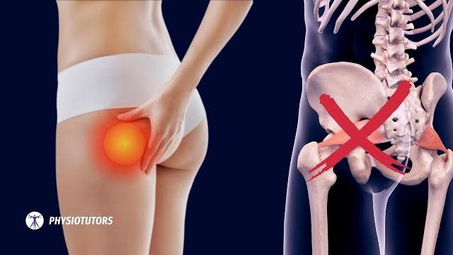Pain in the butt - it's not piriformis syndrome Pain in the butt - it's not piriformis syndrome