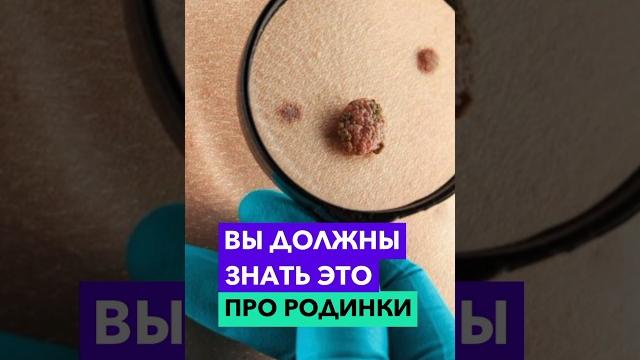 Как понять, нужно ли удалить родинку? Как понять, нужно ли удалить родинку?