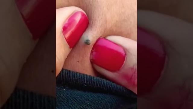 Giant blackhead removal from back 0.1 ! Giant blackhead removal from back 0.1 !