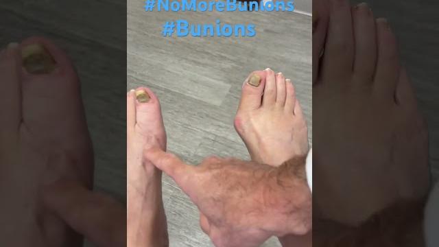  no more bunion pain  no more bunion pain