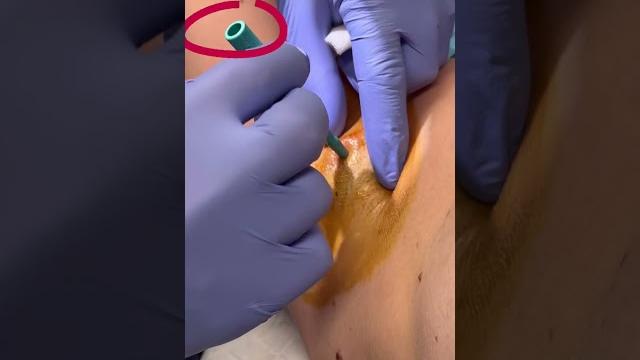 High pressure abscess popped! | 208skindoc High pressure abscess popped! | 208skindoc