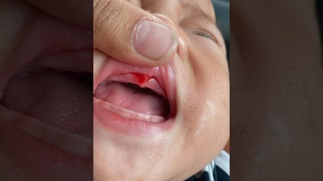 Gusi baby diego berdar4h, dinar nangis kejer #shorts #short Gusi baby diego berdar4h, dinar nangis kejer #shorts #short