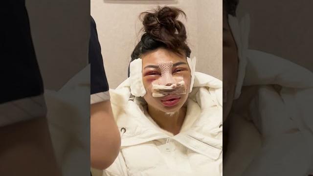 Undergoing a facial contouring surgery in korea Undergoing a facial contouring surgery in korea