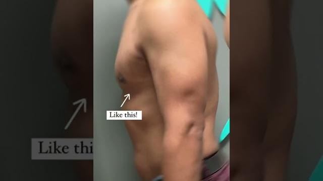 Gynecomastia surgery by dr. lyly at 6 weeks post-op Gynecomastia surgery by dr. lyly at 6 weeks post-op