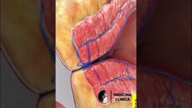 Cirurgia de hemorróida #shorts Cirurgia de hemorróida #shorts