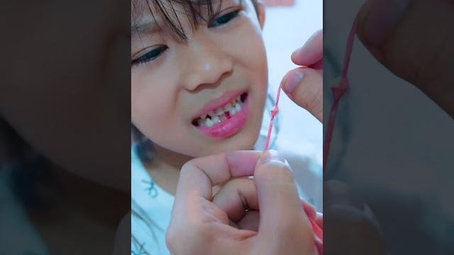 Papoy copotin gigi aletha pakai tali #alethaabew Papoy copotin gigi aletha pakai tali #alethaabew