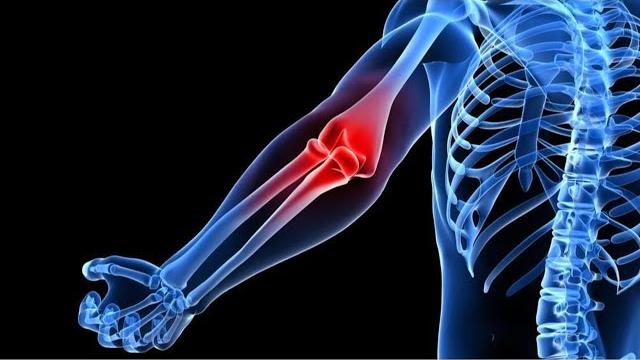Bursitis and tendinitis (bi syndrome) Bursitis and tendinitis (bi syndrome)
