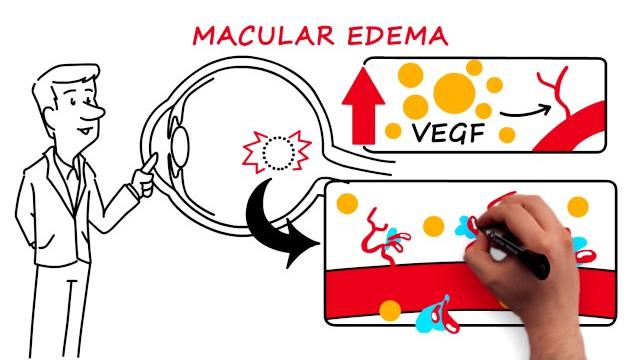 Retinal vein occlusion Retinal vein occlusion