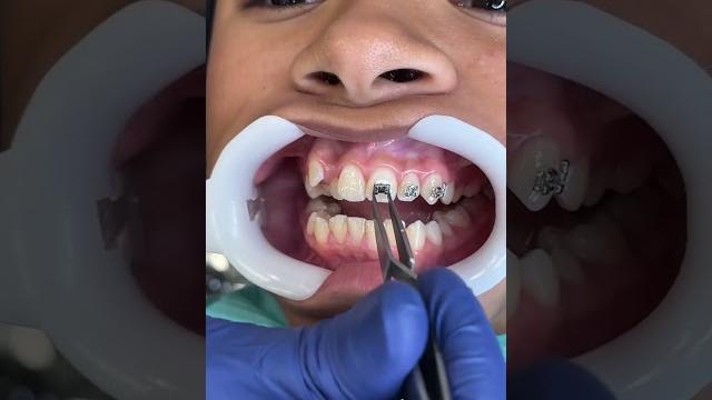Putting braces on Putting braces on