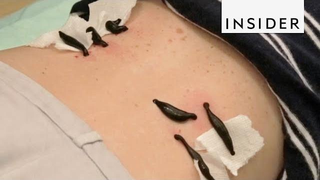 Holistic center performs leech therapy Holistic center performs leech therapy