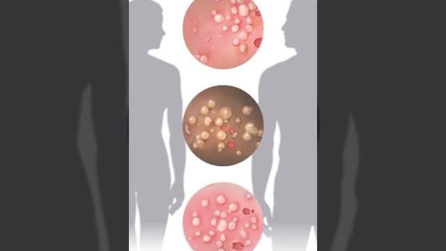 3 warning signs of genital herpes 3 warning signs of genital herpes
