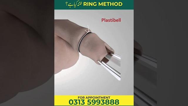 What is ring method circumcision? What is ring method circumcision?