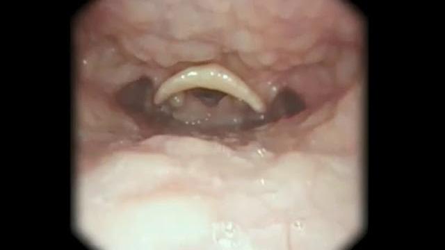 Girl swallowing during a throat exam (visible uvula) Girl swallowing during a throat exam (visible uvula)