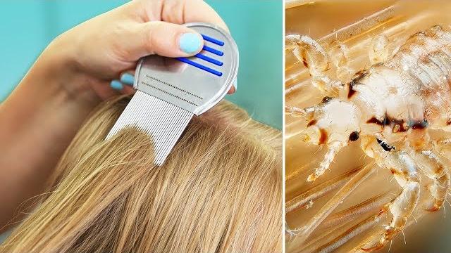 Lice in our house? | tips for natural lice removal & treatment Lice in our house? | tips for natural lice removal & treatment