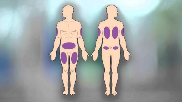 How to give yourself a subcutaneous injection How to give yourself a subcutaneous injection