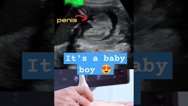 Ultrasound showing boy baby !!! | 25 weeks Ultrasound showing boy baby !!! | 25 weeks