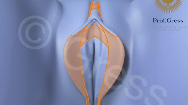 Composite reduction labiaplasty: labia + clitoral hood reduction, correction of clitoral protrusion Composite reduction labiaplasty: labia + clitoral hood reduction, correction of clitoral protrusion