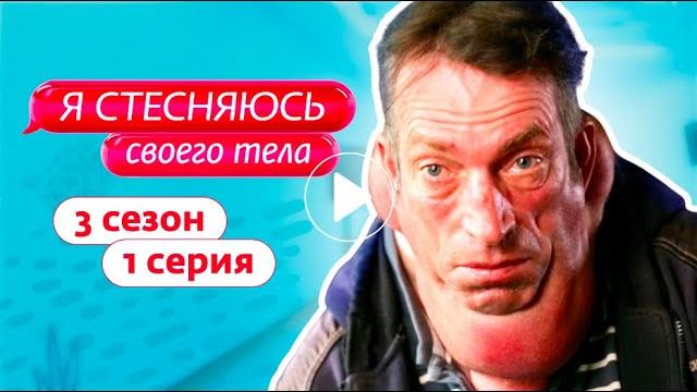 Я стесняюсь своего тела - лечение болезни маделунга - сотрудники фмбц им. а.и. бурназяна фмба россии Я стесняюсь своего тела - лечение болезни маделунга - сотрудники фмбц им. а.и. бурназяна фмба россии