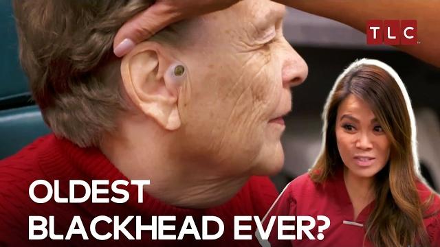 The 55-year blackhead mystery! | dr pimple popper tlc The 55-year blackhead mystery! | dr pimple popper tlc