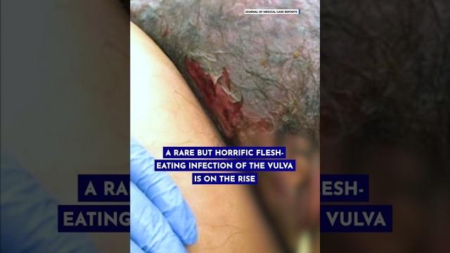‘flesh-eating’ infections of the vulva are on the rise, doctors warn of necrotizing fasciitis ‘flesh-eating’ infections of the vulva are on the rise, doctors warn of necrotizing fasciitis