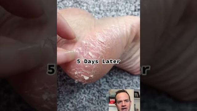 Doctor reacts to chemical foot peel! #shorts #reaction Doctor reacts to chemical foot peel! #shorts #reaction