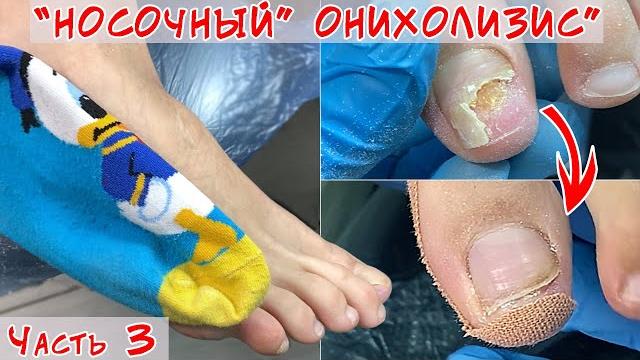 Onycholysis of nails / part 2 / onycholysis due to socks Onycholysis of nails / part 2 / onycholysis due to socks