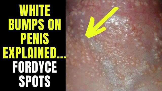 Doctor explains fordyce spots / granules - small white spots or pimples on the penis... Doctor explains fordyce spots / granules - small white spots or pimples on the penis...