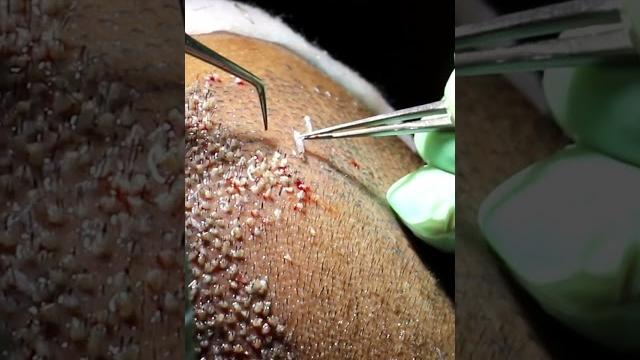 Hair transplant cost in india Hair transplant cost in india