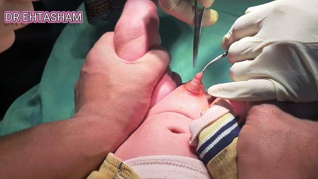 Circumcision by plastibell technique Circumcision by plastibell technique