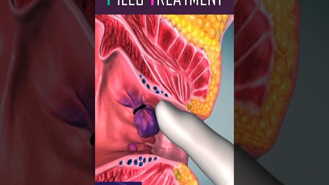 Piles treatment #shorts #piles Piles treatment #shorts #piles