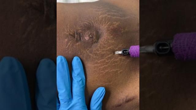 Stretch marks inkless removal boleyn treatment los angeles #shorts Stretch marks inkless removal boleyn treatment los angeles #shorts