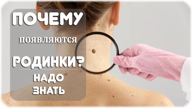Почему появляются родинки? Почему появляются родинки?