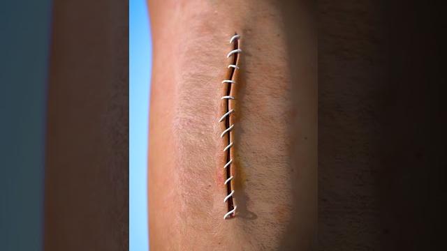 How stitches work How stitches work
