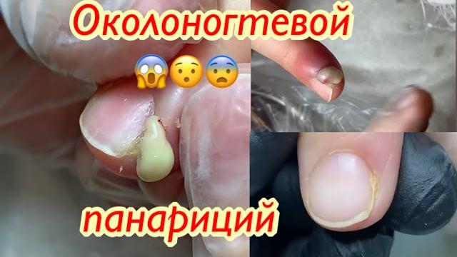 Околоногтевой панариций Околоногтевой панариций