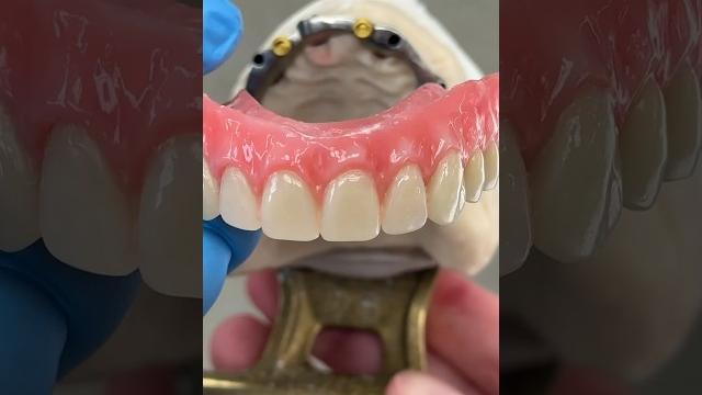 4-locator hybrid #denture #dental #teeth #smile #lsk121shorts @envisiontecmain #envisiontec 4-locator hybrid #denture #dental #teeth #smile #lsk121shorts @envisiontecmain #envisiontec