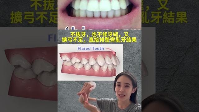 戴牙套後悔,修牙縫造成牙齒敏感?可以選擇不要做片切來改善黑三角 #shorts 戴牙套後悔,修牙縫造成牙齒敏感?可以選擇不要做片切來改善黑三角 #shorts