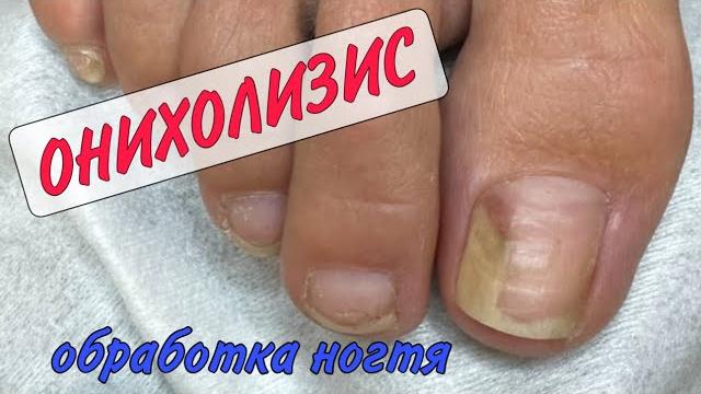 Онихолизис / карман под ногтем / зачистка ногтя Онихолизис / карман под ногтем / зачистка ногтя