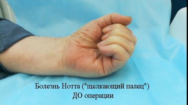 Болезнь нотта, стенозирующий лигаментит, "щелкающий палец". малоинвазивная методика лечения Болезнь нотта, стенозирующий лигаментит, "щелкающий палец". малоинвазивная методика лечения