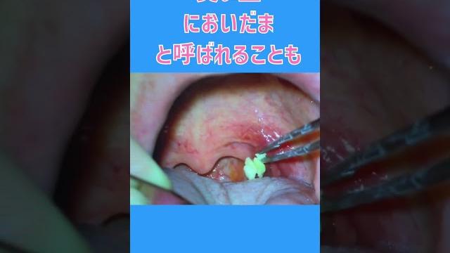 におい玉 扁桃の膿栓 くさい玉 #shorts におい玉 扁桃の膿栓 くさい玉 #shorts