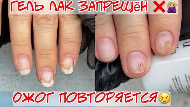 Onycholysis after gel polish and nail burn / what to do? Onycholysis after gel polish and nail burn / what to do?