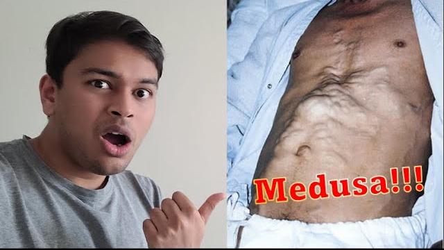 Snakes in his stomach?! | explaining caput medusae and abdominal venous system | doctor squared Snakes in his stomach?! | explaining caput medusae and abdominal venous system | doctor squared
