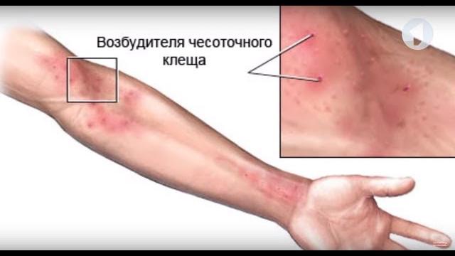 Чесоточный клещ / здравствуйте Чесоточный клещ / здравствуйте